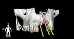 Cummings Blaise 3D View